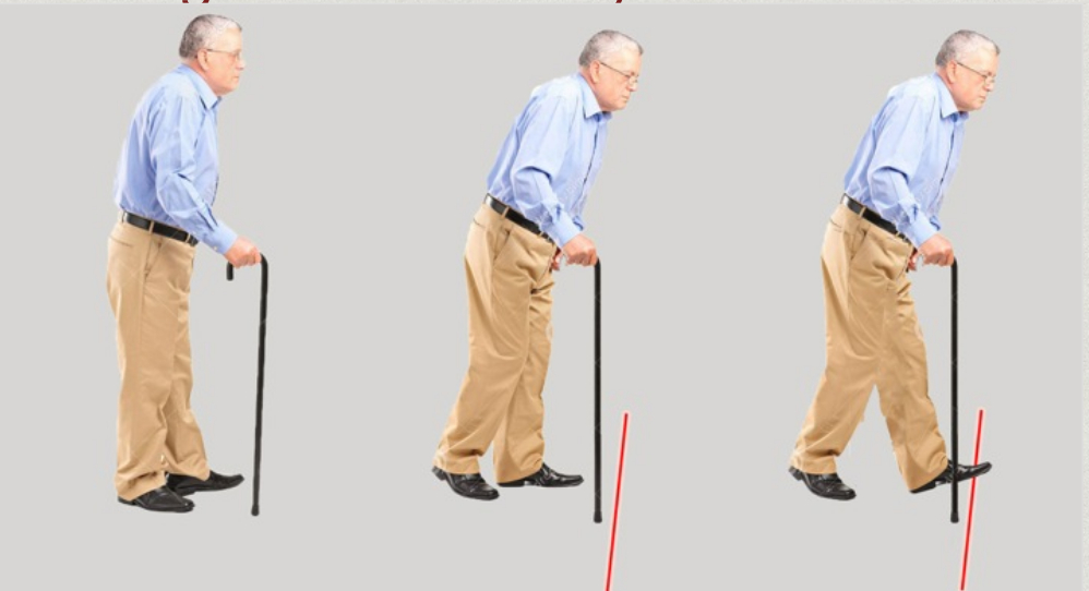 Chalte Raho - Parkinson’s Patients Walking Stick